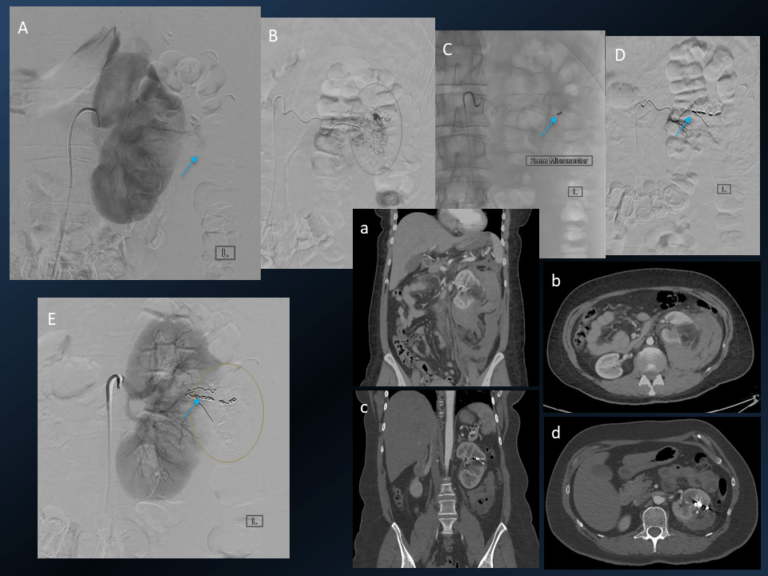 Interventional Radiology - All Your Questions Answered | Guides | RadioGyan