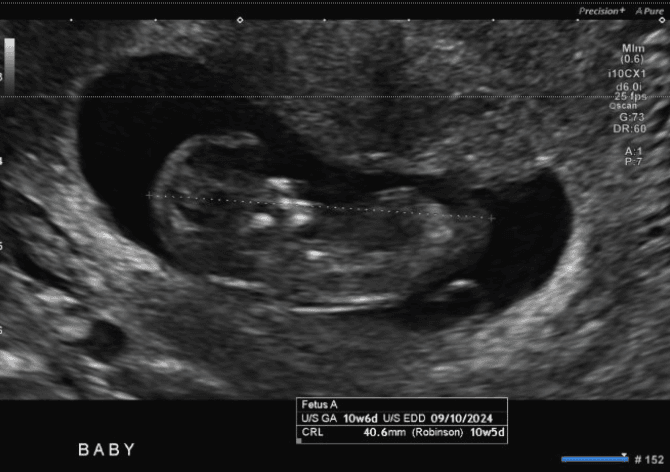 Measuring CRL on first trimester Ultrasound for calculating gestational age