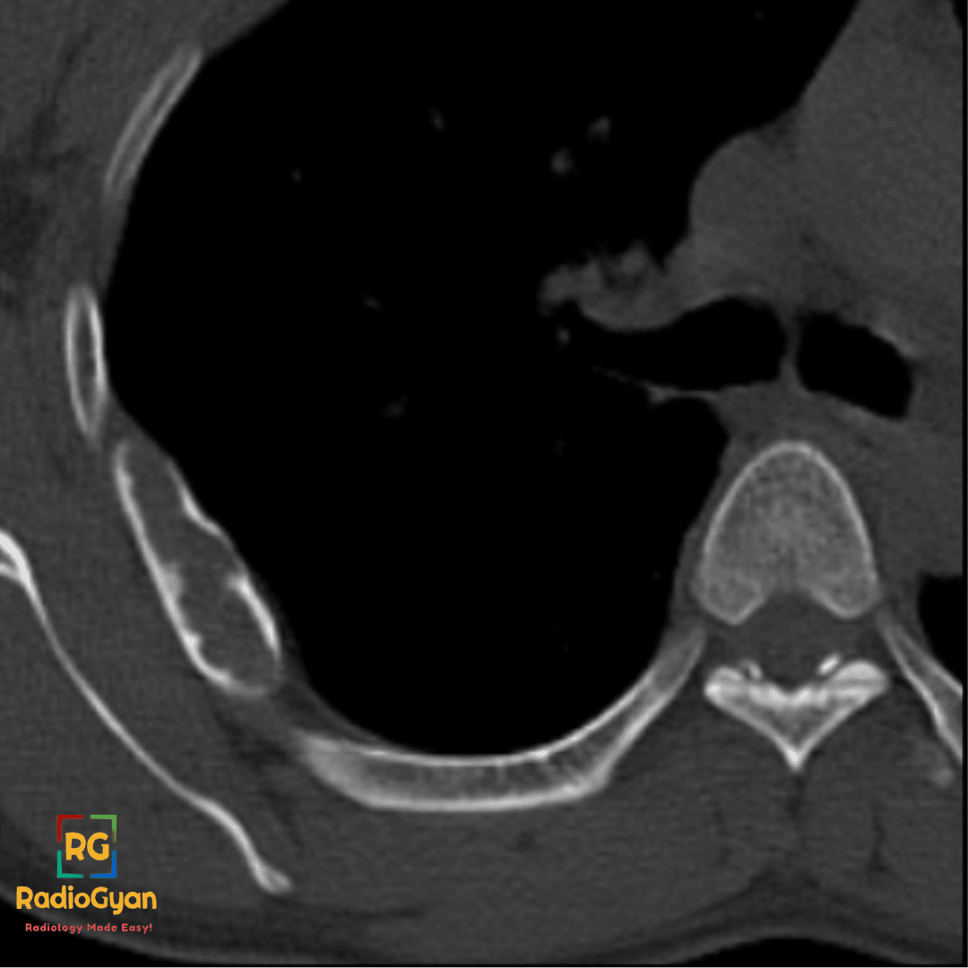 Fibrous Dysplasia of the Rib CT Axial CT image of the chest demonstrating fibrous dysplasia of the rib