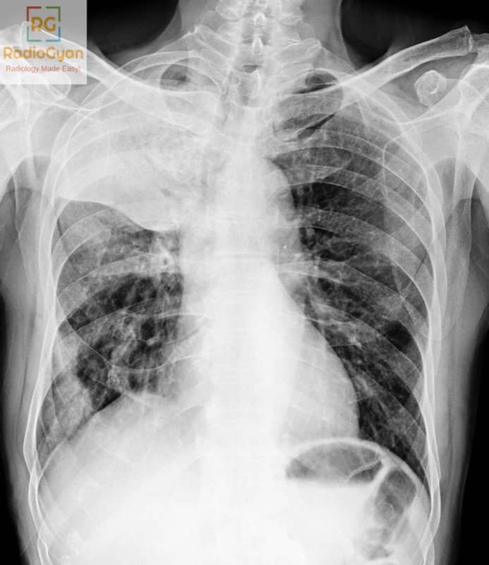 Golden S Sign Chest Radiograph Radiology Signs AP chest radiograph demonstrates right upper lobe collapse with an associated hilar mass forming the "Golden S" sign.