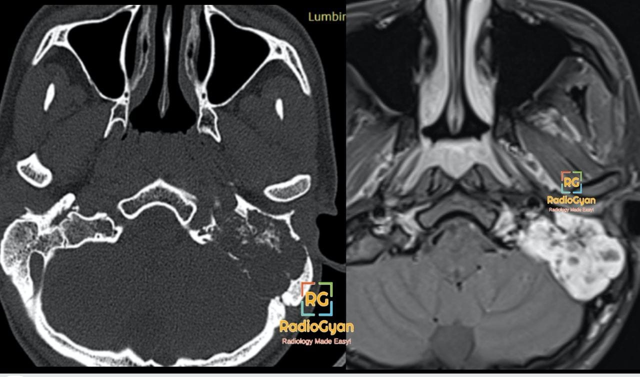 Axial CT and MRI images reveal a mass centered at the left glomus jugulare, extending into the internal auditory canal, with associated bony erosion in keeping with a paraganglioma
